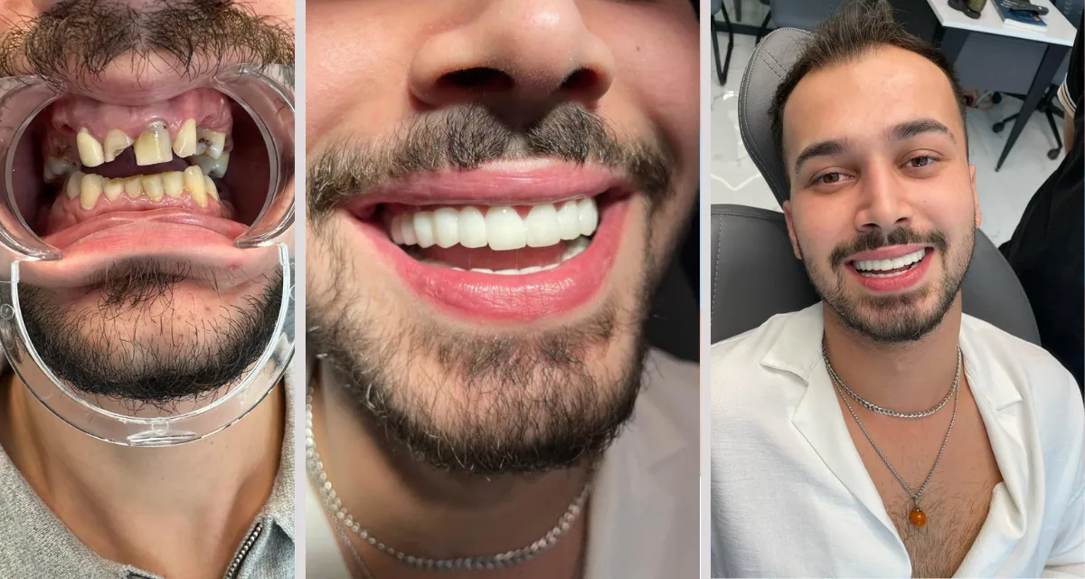 Dental Crowns